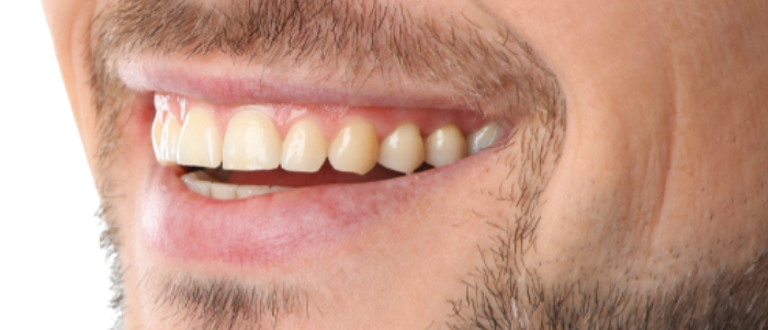 Smiling man showcasing improved dental aesthetics with bright, healthy teeth, reflecting effective dental treatments at Harborside Dental.
