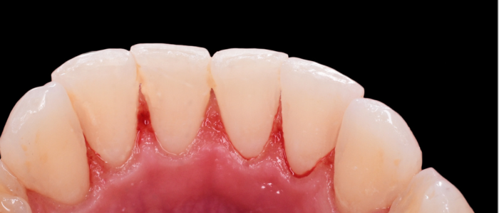 Dental hygiene improvement after cleaning, showcasing healthy teeth and gums, emphasizing dental care effectiveness.