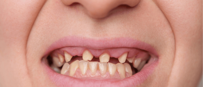Before-and-after comparison of a patient's smile showing dental issues such as gaps and misalignment, emphasizing the transformative effects of dental treatments at Harborside Dental.