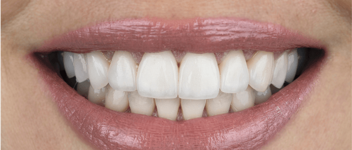 Close-up of a bright, healthy smile with straight, white teeth, showcasing the results of dental treatments at Harborside Dental.