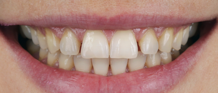 Close-up of a smile showcasing uneven, discolored teeth before dental treatment, illustrating the need for cosmetic improvements in oral health.