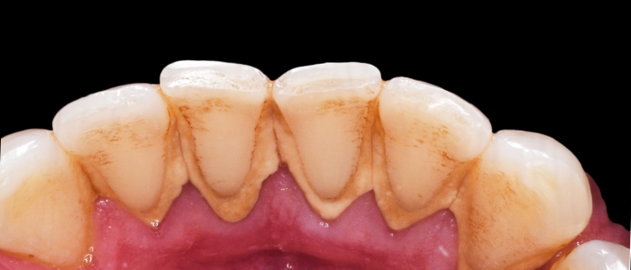 Close-up of teeth showing plaque buildup and gum health, highlighting the importance of dental cleaning and care at Harborside Dental.