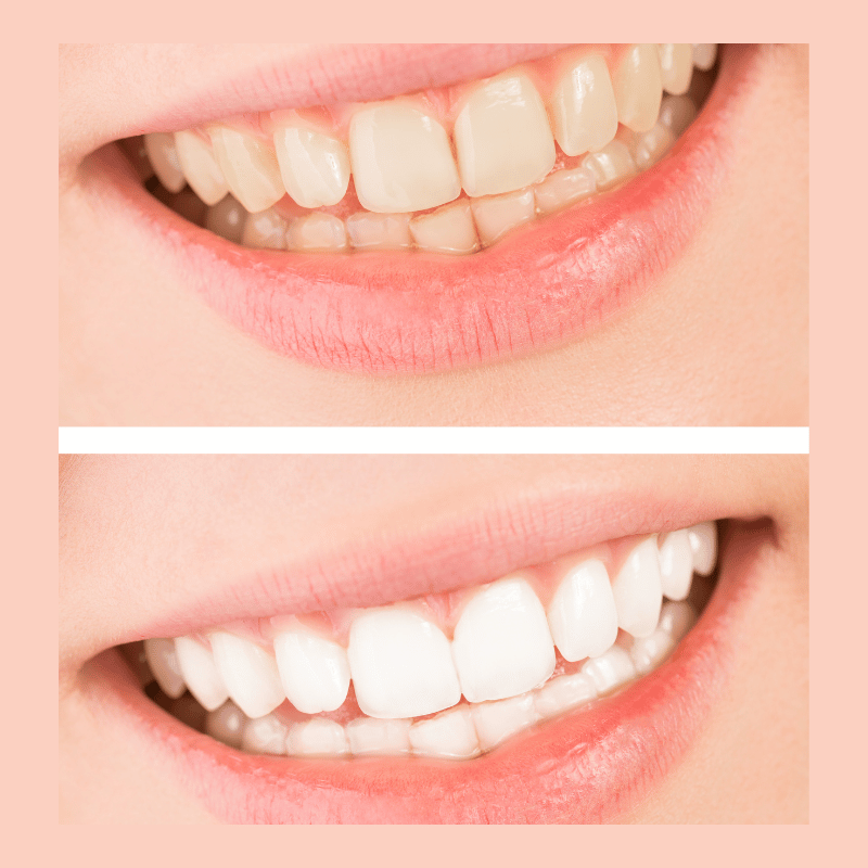 Before and after comparison of teeth whitening results, showcasing improved tooth color and smile appearance.